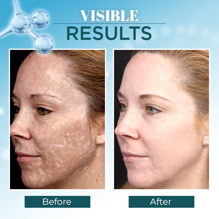 Lanthome™ Dark Spot Corrector Remover