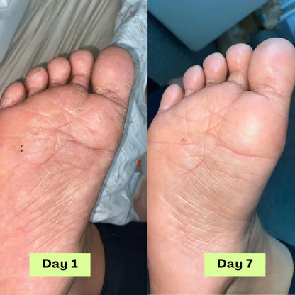 NEGUSY™ Tea Tree Athlete's Foot Defense Soap