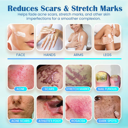 Seurico™ Eczema, Psoriasis Cream