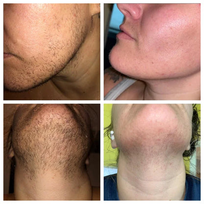 PCOS Facial Hair Natural Treatment At Home